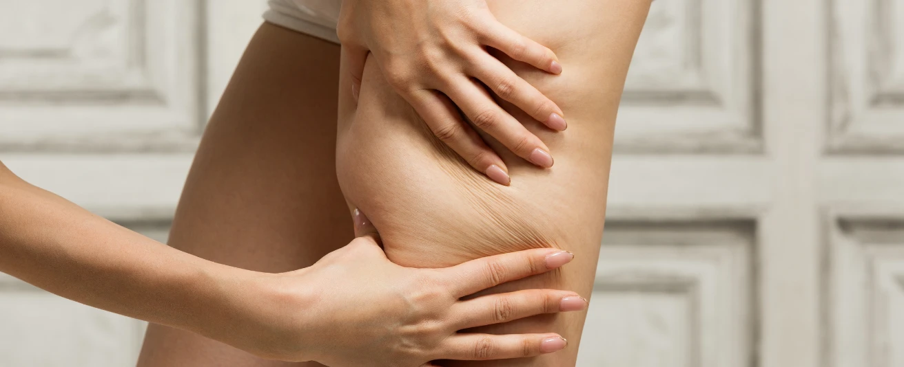 O que é lipedema?