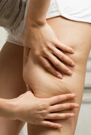O que é lipedema?